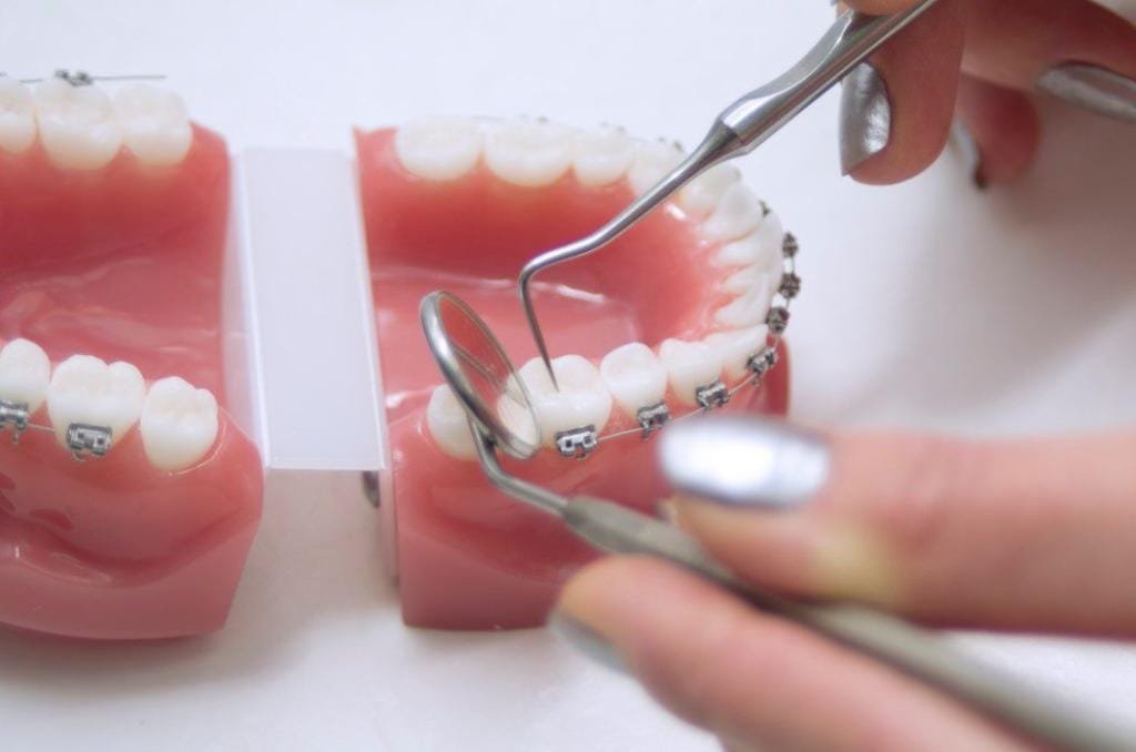 Treatment Options For Severe Tooth Decay That Teens Should Know About