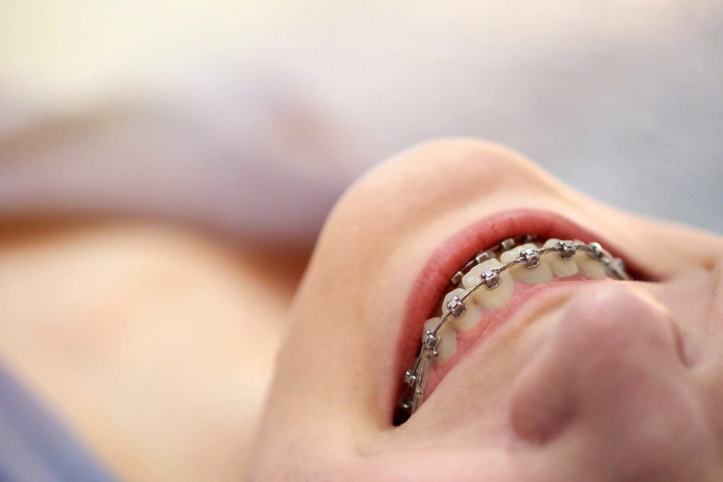 Why Braces Don’t Need to Be a Source of Stress