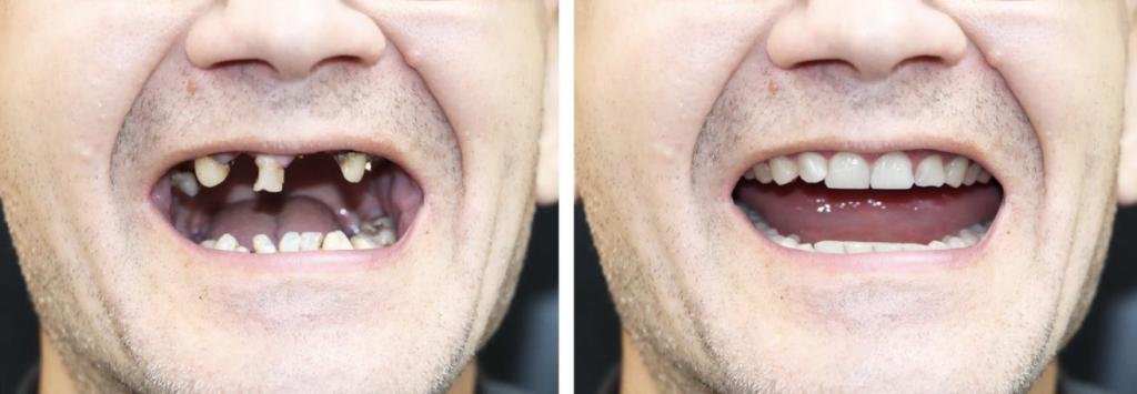 Tooth Loss — Is There a Way to Avoid It?