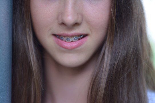 Steps You Need to Take before Getting Braces