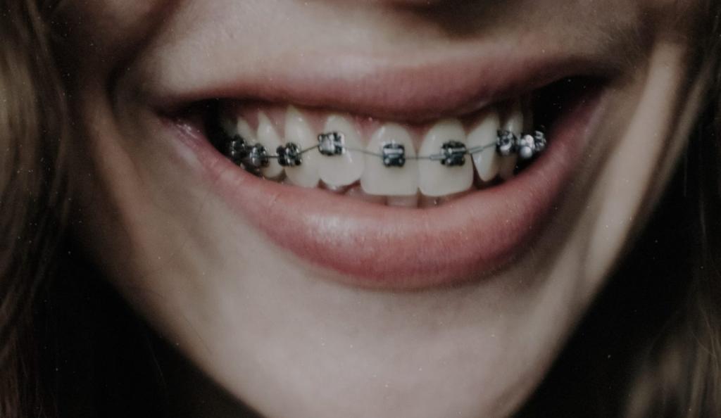 Mistakes Teens Make After Getting Their Braces Removed