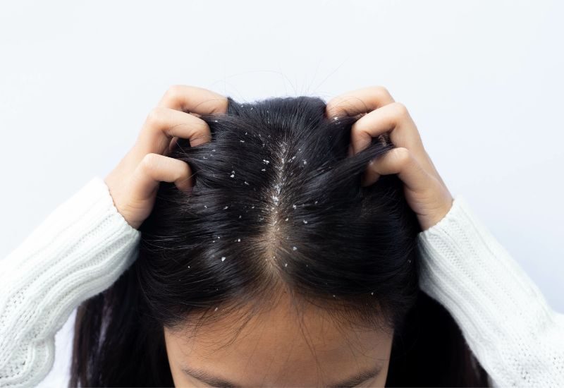 Easy Ways That You Can Eliminate Dandruff